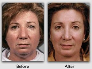 plastic miami surgery facial