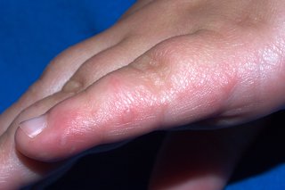 foot hand mouth disease causes adults in