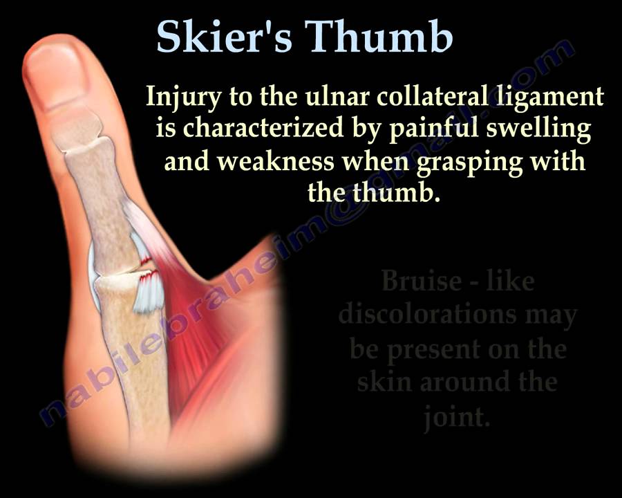 collateral thumb ligament of