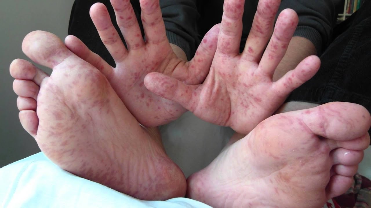 causes foot in adults mouth hand disease