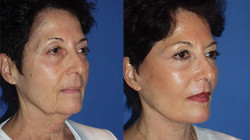 plastic miami surgery facial