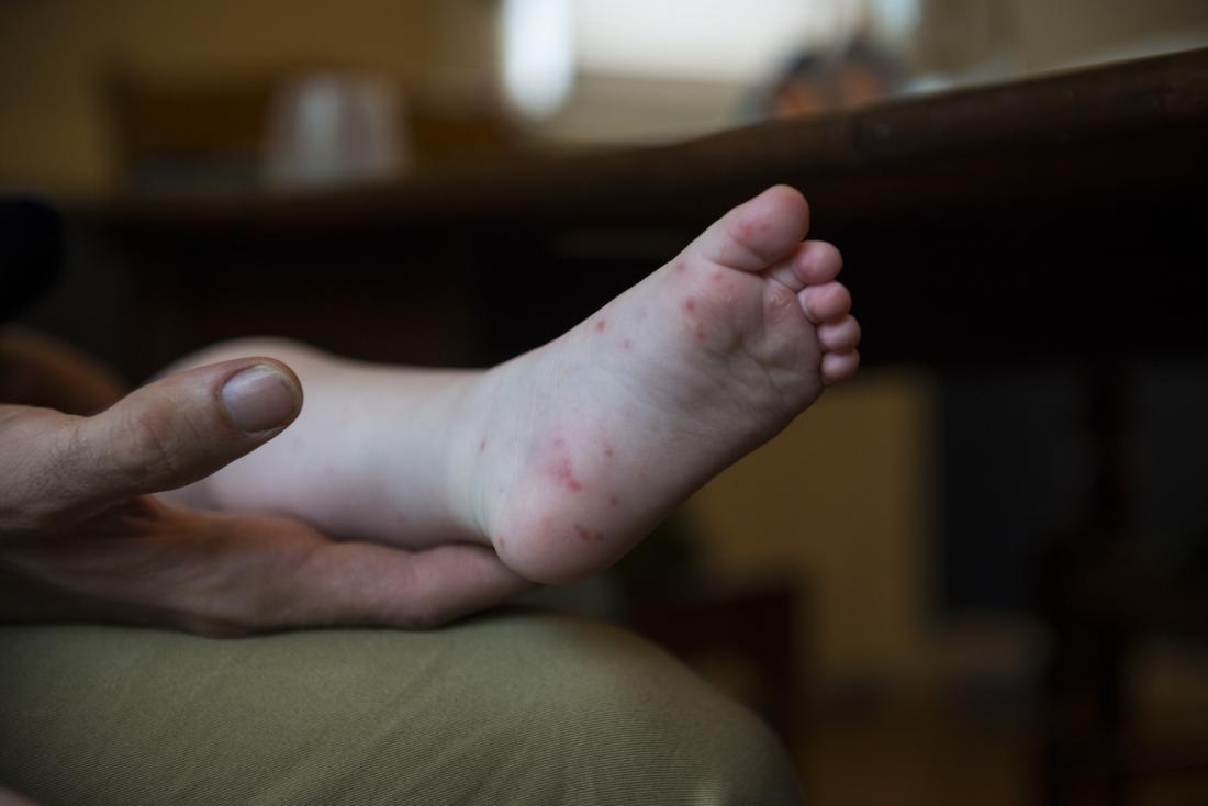causes mouth in disease foot hand adults