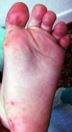 causes foot adults disease mouth hand in