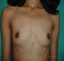 breast prices for argumentation