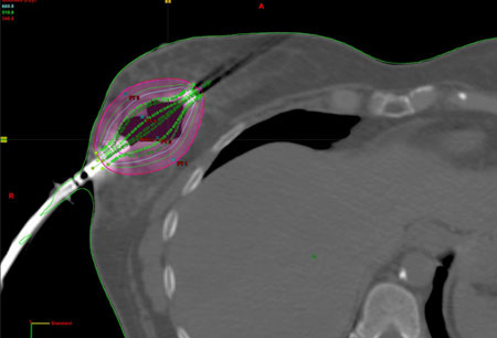 breast partial radiation accelerated