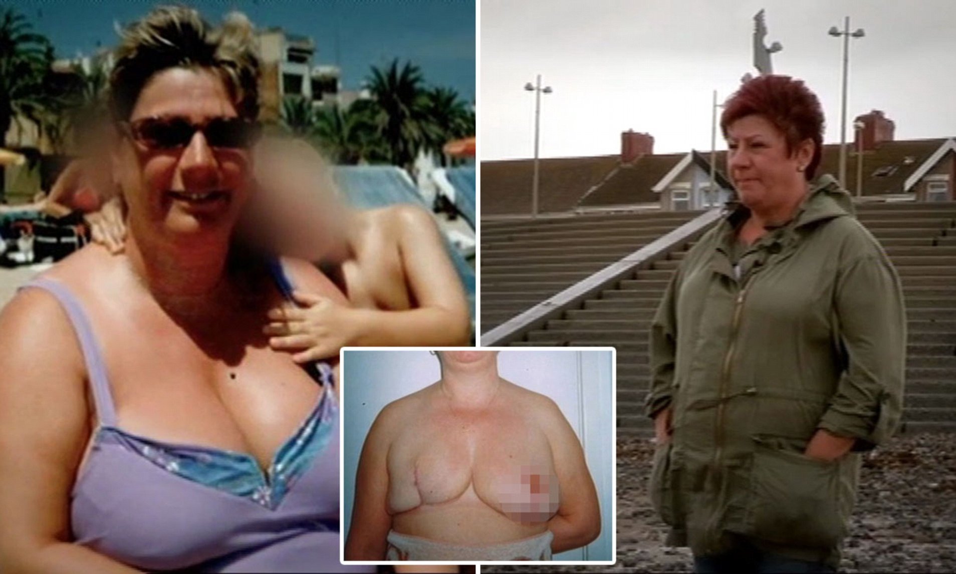breast reductions botched